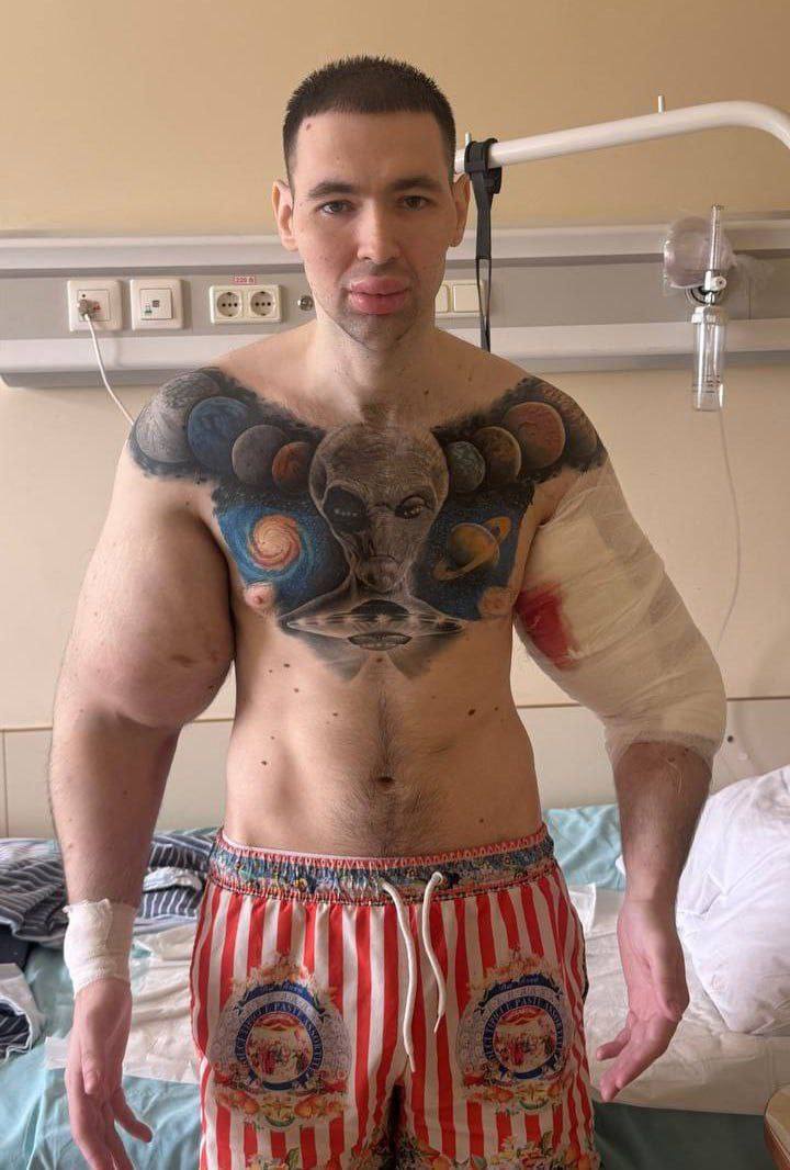 Кириллу Терёшину может потребоваться ампутация рук