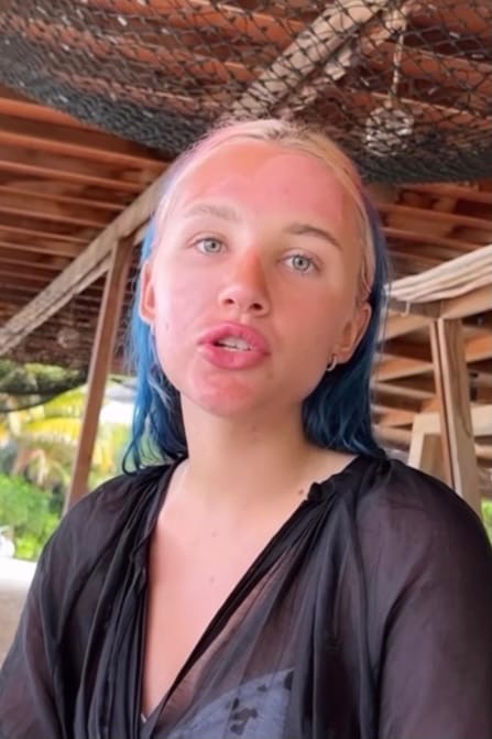 Миа Бойка переборщила с солнечными ваннами