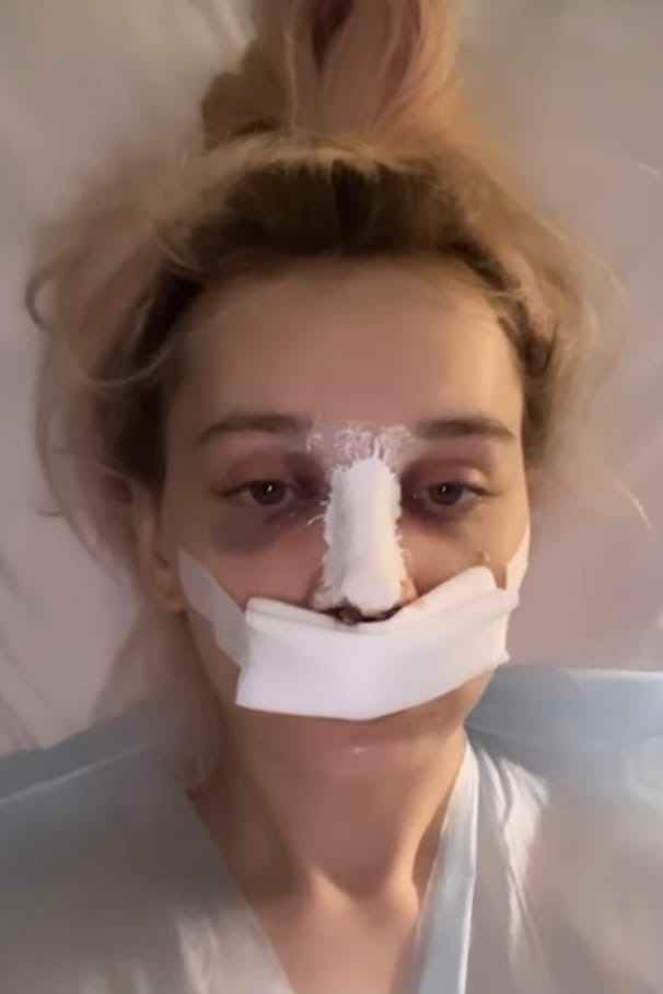 Даше Корейка сделали ринопластику