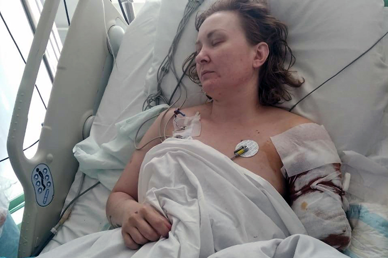 Кадр из новости Жительнице Подмосковья ампутировали руку после нападения алабая.