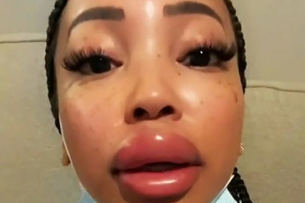 Кадр из новости У блогерши Мишель Эстрады после неудачной коррекции распухли губы